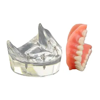 Стоматологическая обучающая модель для изучения зубов Демонстрационная модель имплантата Overdenture Inferior 4